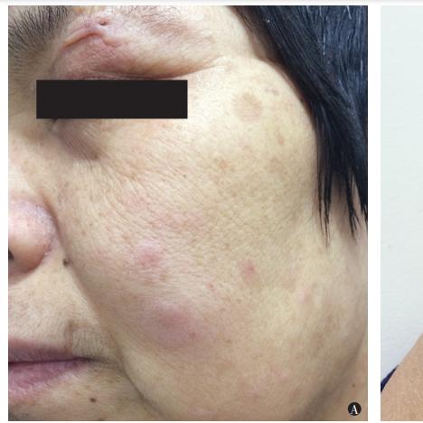 荨麻疹怎么治疗能除根(寒冷性荨麻疹怎么治疗能除根) 荨麻疹怎么治疗能除根(寒冷性荨麻疹怎么治疗能除根)